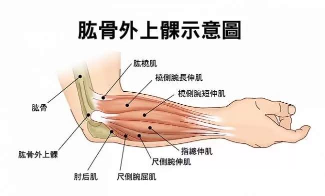 别再以为网球肘是运动员专属！你的鼠标手、妈妈手，可能都是它在作祟！